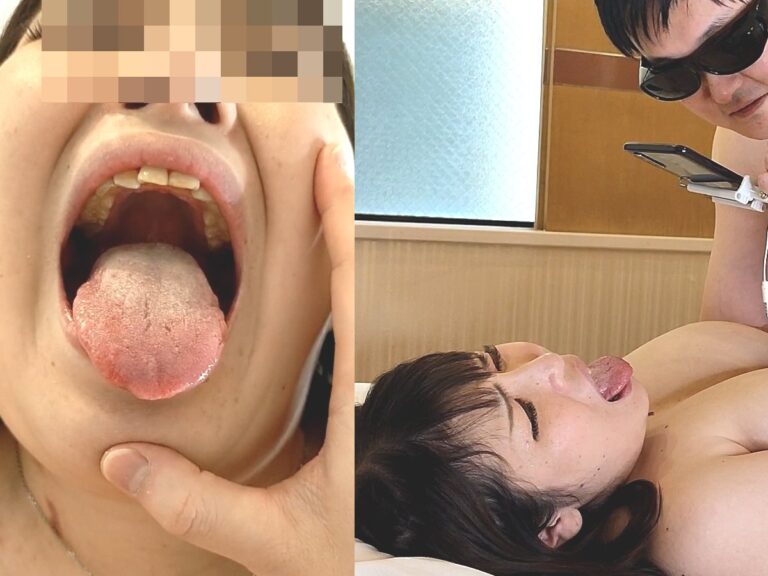 激クサ黄色の汚舌!!【Hカップ爆乳ぽちゃ美女】極上BBW★ 歯医者変態プレイ!!大口を開けさせ、口腔内を楽しみ、鼻舐め&口臭を嗅ぎながら、1週間溜めた精子を生ハメ中出し